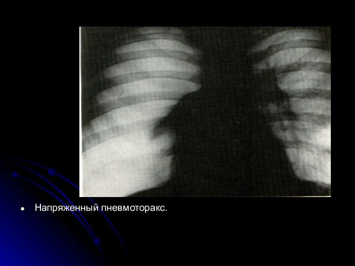 Напряженный пневмоторакс.