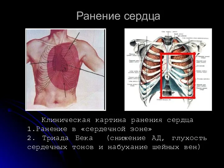 Ранение сердца Клиническая картина ранения сердца 1.Ранение в «сердечной зоне»