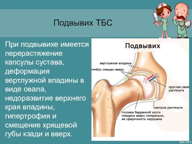 Подвывих ТБС При подвывихе имеется перерастяжение капсулы сустава, деформация вертлужной впадины в виде