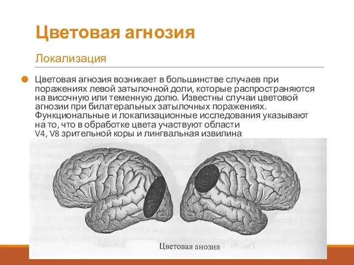 Цветовая агнозия возникает в большинстве случаев при поражениях левой затылочной