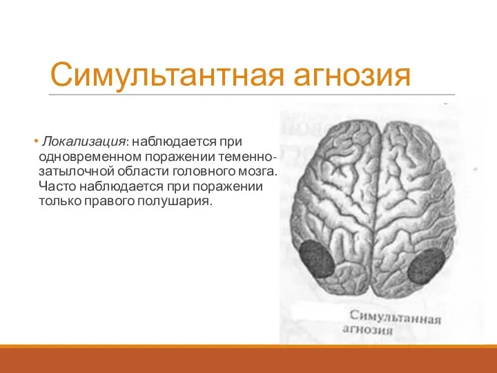 Симультантная агнозия Локализация: наблюдается при одновременном поражении теменно-затылочной области головного