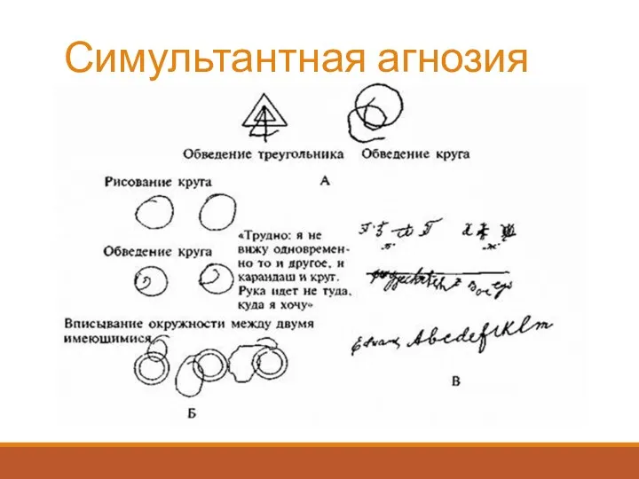 Симультантная агнозия