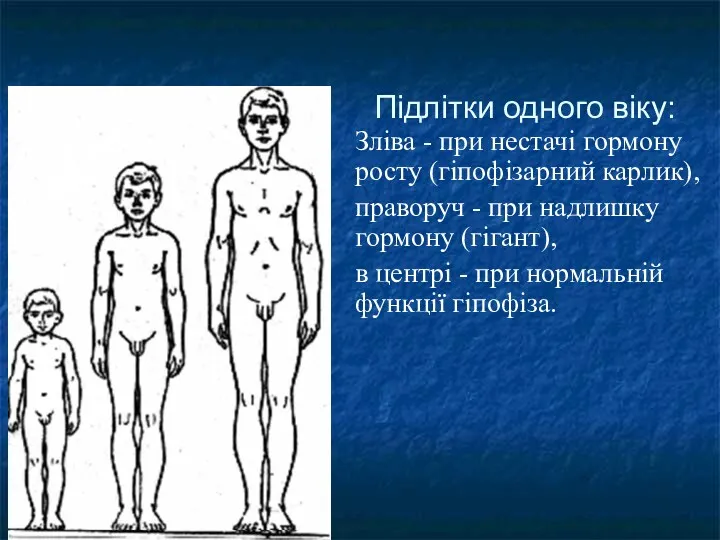 Підлітки одного віку: Зліва - при нестачі гормону росту (гіпофізарний
