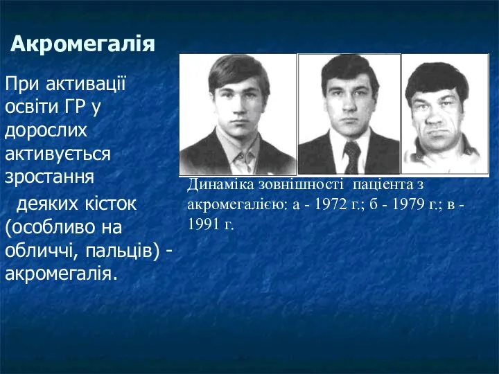 Акромегалія При активації освіти ГР у дорослих активується зростання деяких