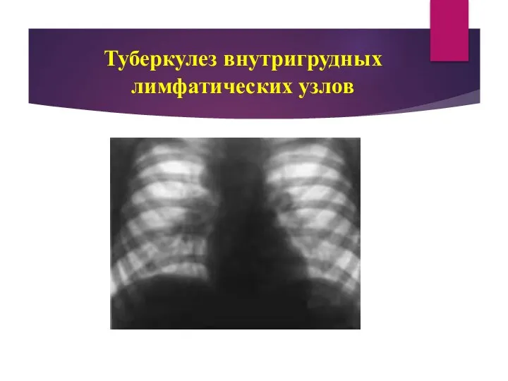 Туберкулез внутригрудных лимфатических узлов