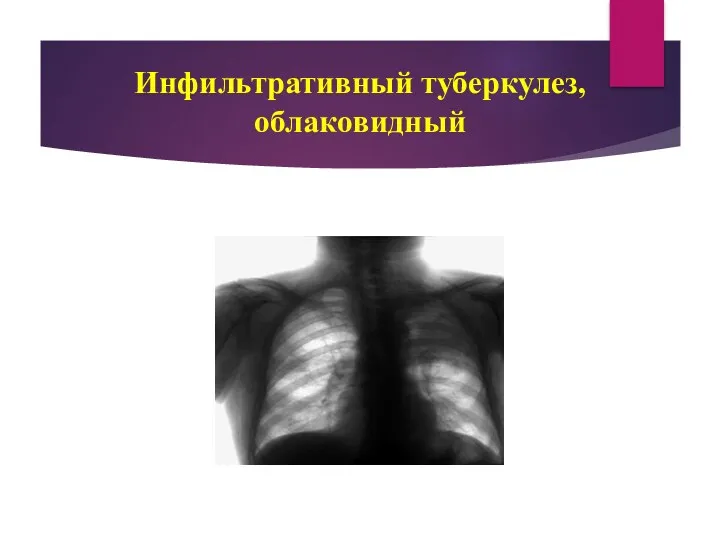Инфильтративный туберкулез, облаковидный