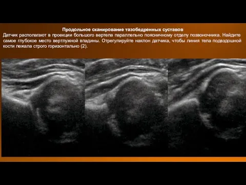 Продольное сканирование тазобедренных суставов Датчик располагают в проекции большого вертела