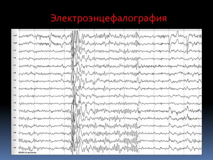 Электроэнцефалография