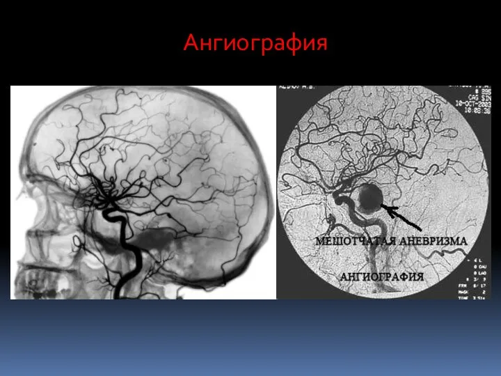 Ангиография