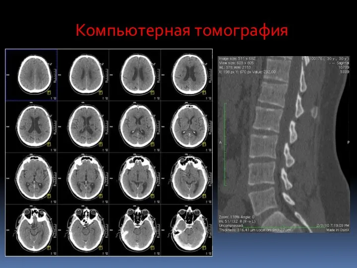 Компьютерная томография