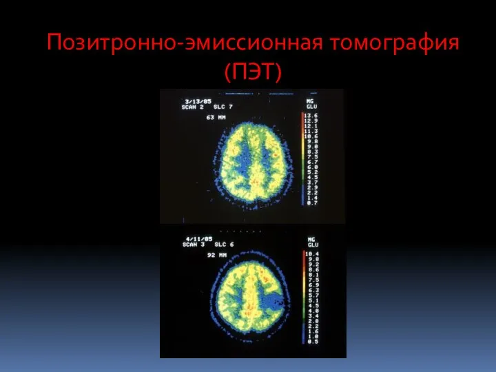 Позитронно-эмиссионная томография (ПЭТ)