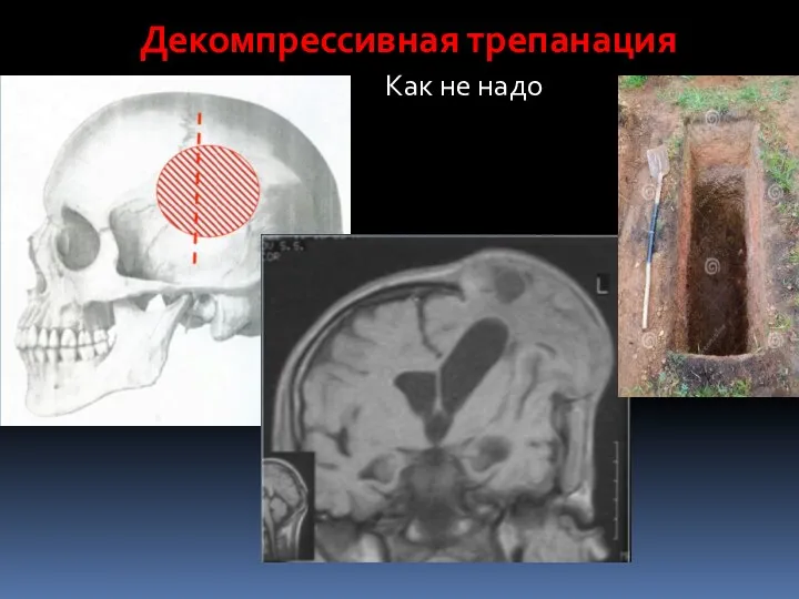 Декомпрессивная трепанация Как не надо