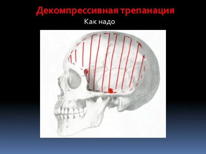 Декомпрессивная трепанация Как надо