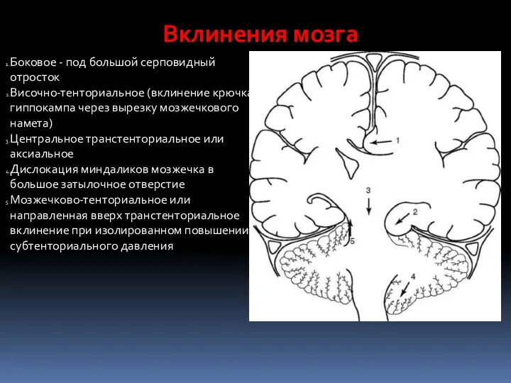 Вклинения мозга Боковое - под большой серповидный отросток Височно-тенториальное (вклинение