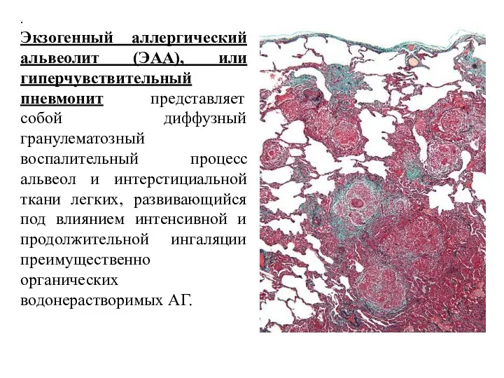 . Экзогенный аллергический альвеолит (ЭАА), или гиперчувствительный пневмонит представляет собой