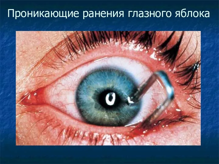 Проникающие ранения глазного яблока