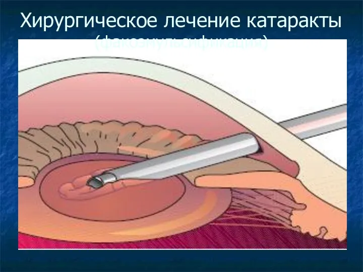 Хирургическое лечение катаракты (факоэмульсификация)