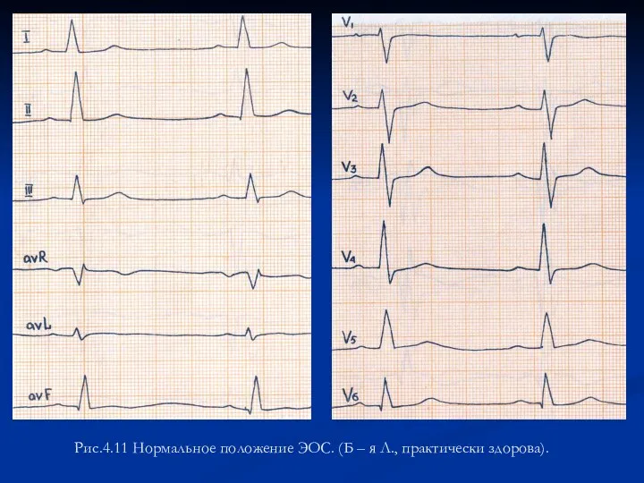 Рис.4.11 Нормальное положение ЭОС. (Б – я Л., практически здорова).