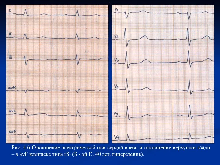 Рис. 4.6 Отклонение электрической оси сердца влево и отклонение верхушки кзади – в