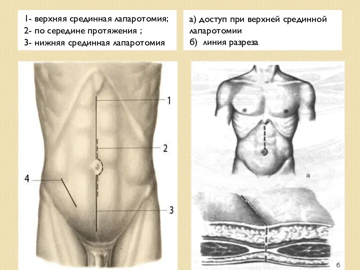 1- верхняя срединная лапаротомия; 2- по середине протяжения ; 3-