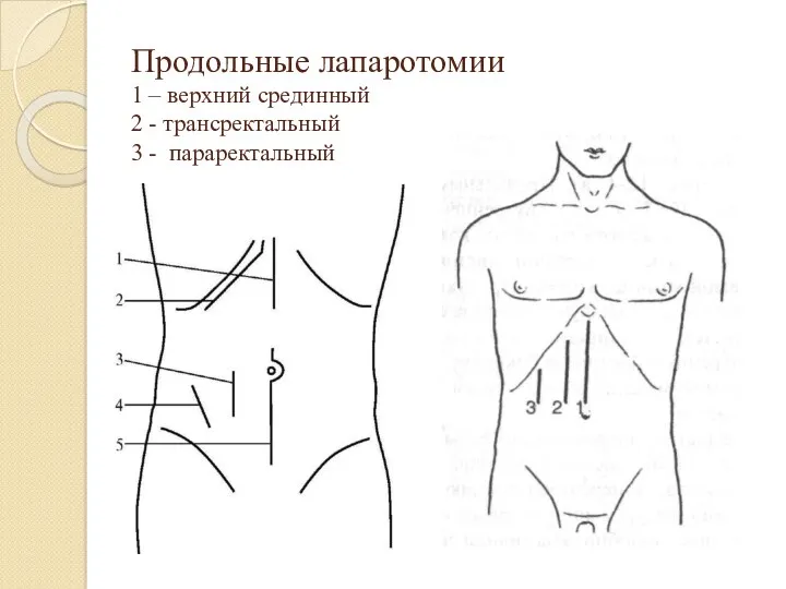 Продольные лапаротомии 1 – верхний срединный 2 - трансректальный 3 - параректальный