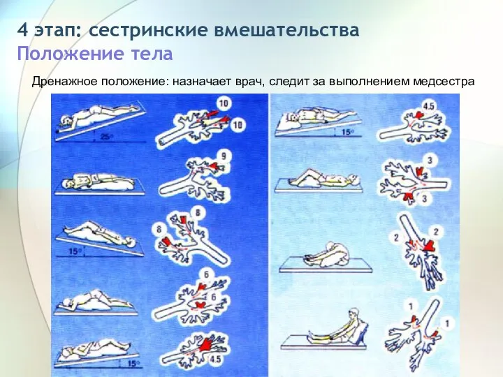 4 этап: сестринские вмешательства Положение тела Дренажное положение: назначает врач, следит за выполнением медсестра