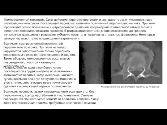 Компрессионный механизм. Сила действует строго по вертикали и совпадает с