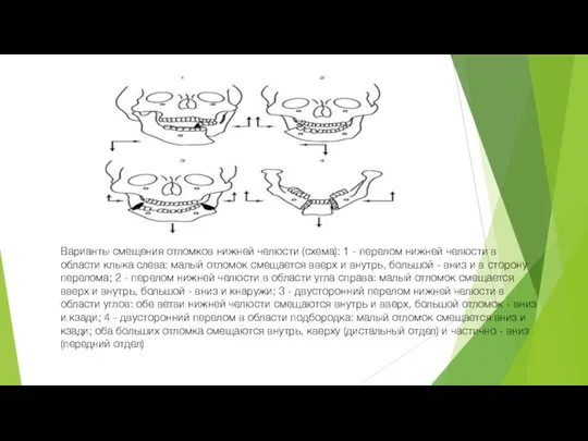 Варианты смещения отломков нижней челюсти (схема): 1 - перелом нижней