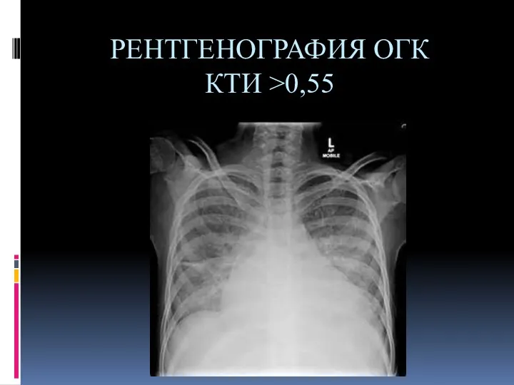 РЕНТГЕНОГРАФИЯ ОГК КТИ >0,55