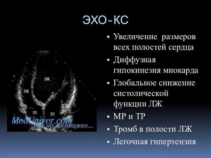 ЭХО-КС Увеличение размеров всех полостей сердца Диффузная гипокинезия миокарда Глобальное