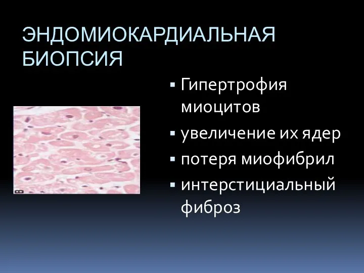 ЭНДОМИОКАРДИАЛЬНАЯ БИОПСИЯ Гипертрофия миоцитов увеличение их ядер потеря миофибрил интерстициальный фиброз