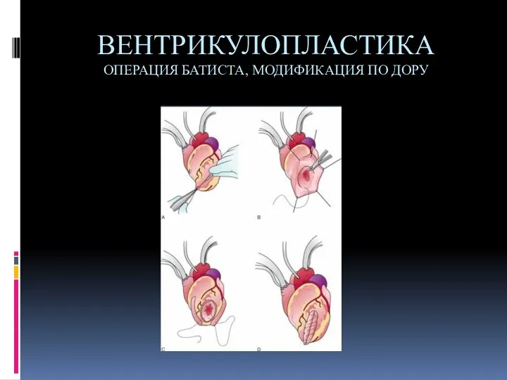 ВЕНТРИКУЛОПЛАСТИКА ОПЕРАЦИЯ БАТИСТА, МОДИФИКАЦИЯ ПО ДОРУ