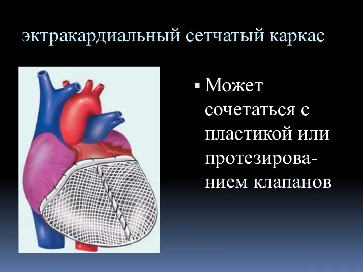 эктракардиальный сетчатый каркас Может сочетаться с пластикой или протезирова-нием клапанов