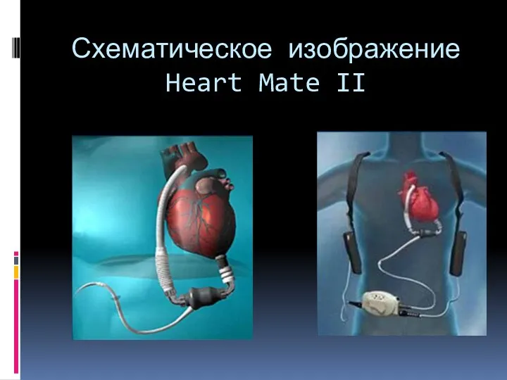 Схематическое изображение Heart Mate II