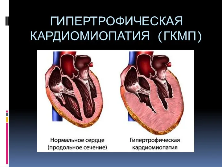 ГИПЕРТРОФИЧЕСКАЯ КАРДИОМИОПАТИЯ (ГКМП)