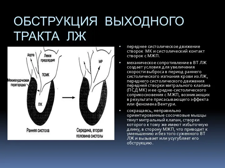 ОБСТРУКЦИЯ ВЫХОДНОГО ТРАКТА ЛЖ переднее систолическое движение створок МК и