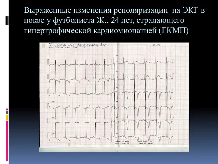 Выраженные изменения реполяризации на ЭКГ в покое у футболиста Ж., 24 лет, страдающего гипертрофической кардиомиопатией (ГКМП)