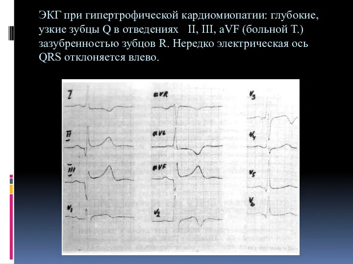 ЭКГ при гипертрофической кардиомиопатии: глубокие, узкие зубцы Q в отведениях