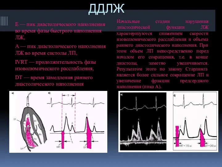 ДДЛЖ Е — пик диастолического наполнения во время фазы быстрого