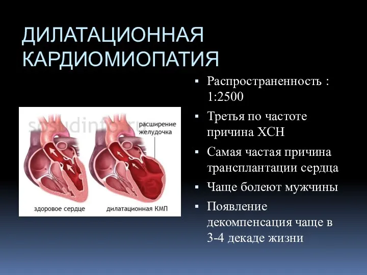 ДИЛАТАЦИОННАЯ КАРДИОМИОПАТИЯ Распространенность : 1:2500 Третья по частоте причина ХСН