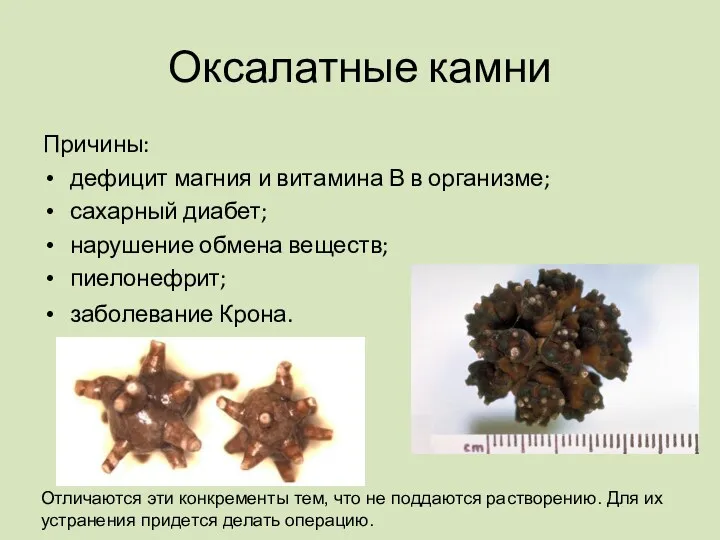 Оксалатные камни Причины: дефицит магния и витамина В в организме;