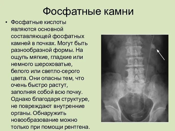 Фосфатные камни Фосфатные кислоты являются основной составляющей фосфатных камней в