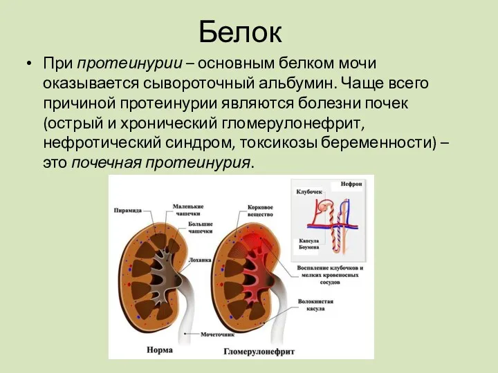 При протеинурии – основным белком мочи оказывается сывороточный альбумин. Чаще
