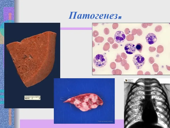 Патогенез.