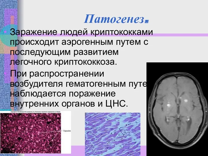 Патогенез. Заражение людей криптококками происходит аэрогенным путем с последующим развитием