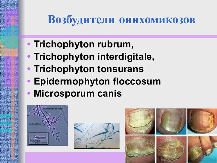 Возбудители онихомикозов Trichophyton rubrum, Trichophyton interdigitale, Trichophyton tonsurans Epidermophyton floccosum Microsporum canis