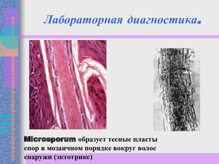 Лабораторная диагностика. Microsporum образует тесные пласты спор в мозаичном порядке вокруг волос снаружи (эктотрикс)