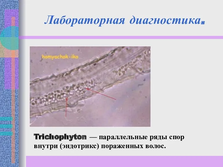 Лабораторная диагностика. Trichophyton — параллельные ряды спор внутри (эндотрикс) пораженных волос.