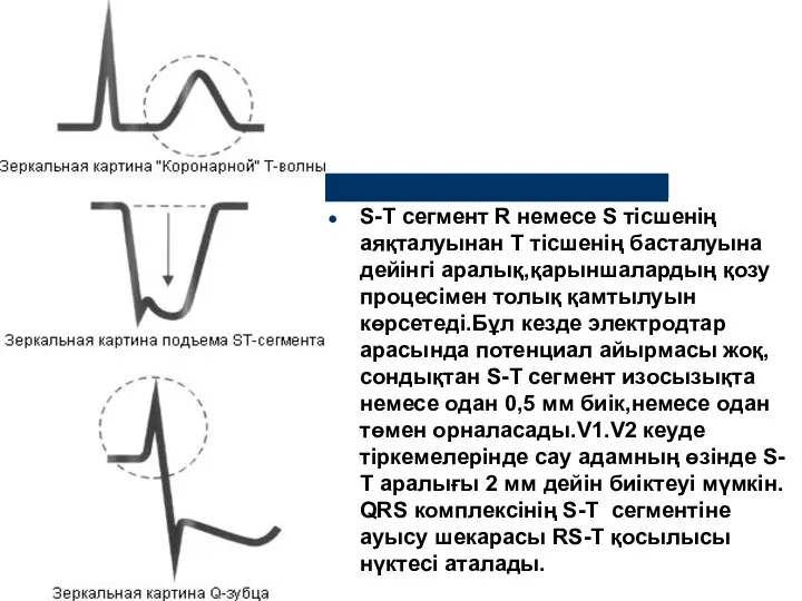 S-Т сегмент R немесе S тісшенің аяқталуынан Т тісшенің басталуына дейінгі аралық,қарыншалардың қозу