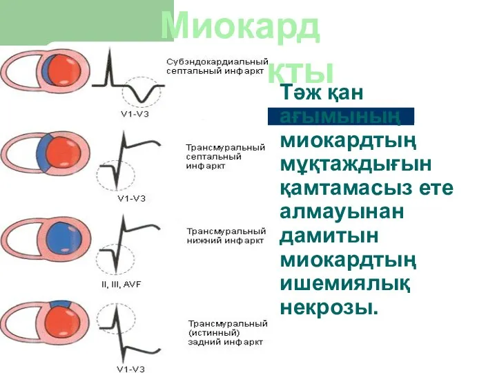 Тәж қан ағымының миокардтың мұқтаждығын қамтамасыз ете алмауынан дамитын миокардтың ишемиялық некрозы. Миокард инфаркты